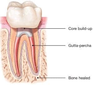 can you travel with root canal