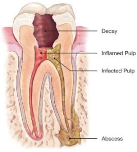 Diagram of infected tooth