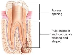 can you drive right after a root canal