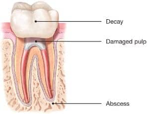 endodontic treatment can often be performed in one or two visits and involves the following steps