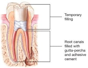 Root Canal vs Filling: What Procedure Do I Need? - Putney Dental Care