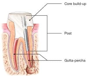 Can You Drink Alcohol After Root Canal?