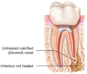 「aBSCESS ROOT CANAL」の画像検索結果