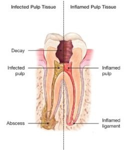 tooth that needs root canal