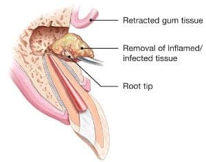 Apicoectomy Procedure: A Root End Surgery