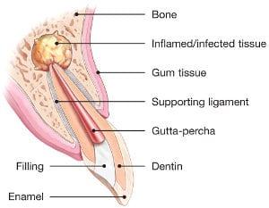 Dental Filling Pre-Operative Instructions