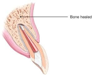 Apicoectomy Procedure: A Root End Surgery