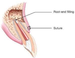 Apicoectomy Procedure: A Root End Surgery