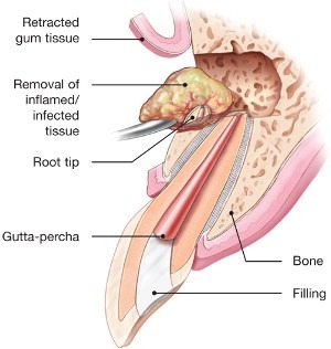 Root Canal Therapy – Maple Ridge Endodontics