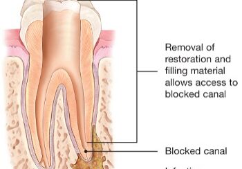 endodontic-retreatment-canal