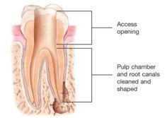 EndoTreatment_TOOTH_p7b EndoTreatment_TOOTH_p7b