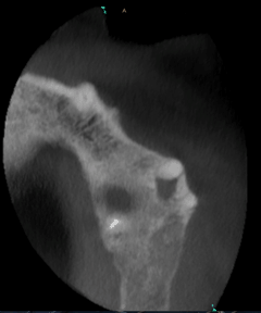 Pre-op CBCT Axial View