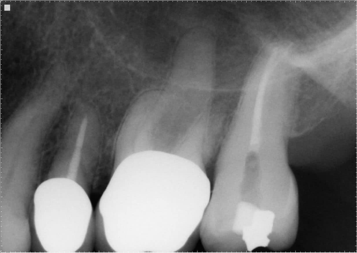 Case Challenge Figure 3 Post-op PA from 2019