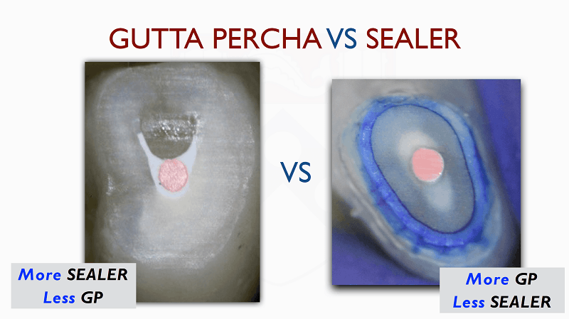 Gutta percha vs. sealer graphic