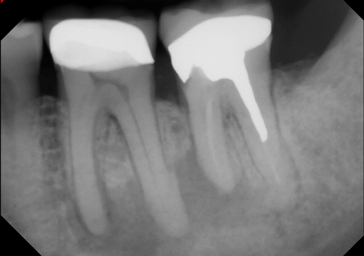 Periapical Abscess Histology