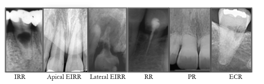 Resorption cavity rings and localized vascular changes within the