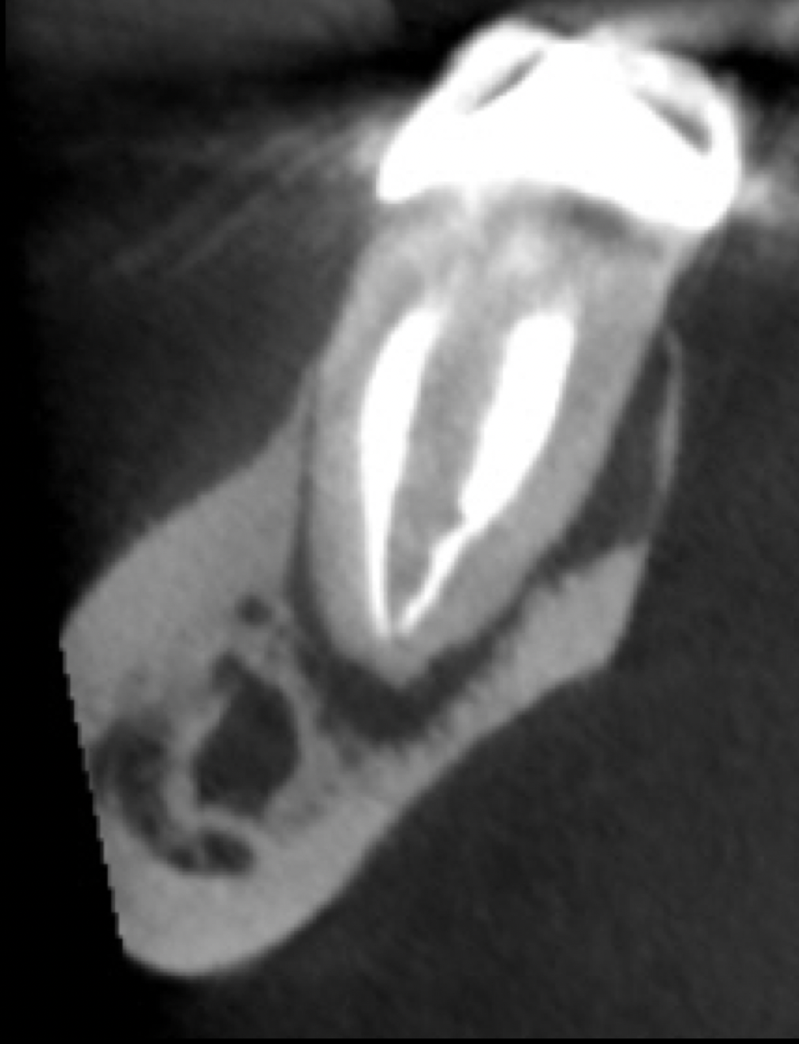 Cracked Teeth - St. Albert Endodontics