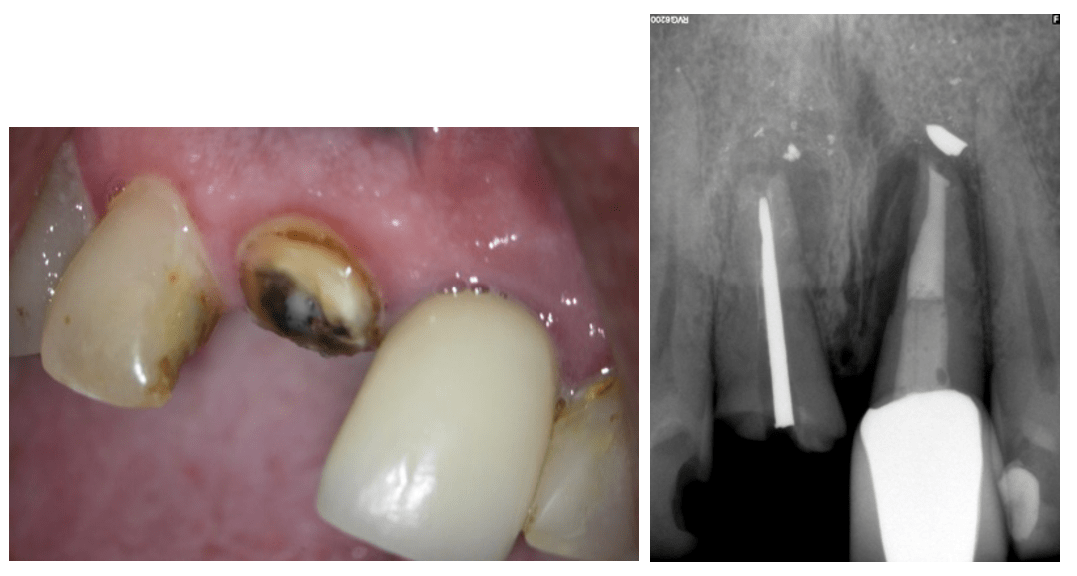 Treating Patients with Disabilities An Endodontic Perspective