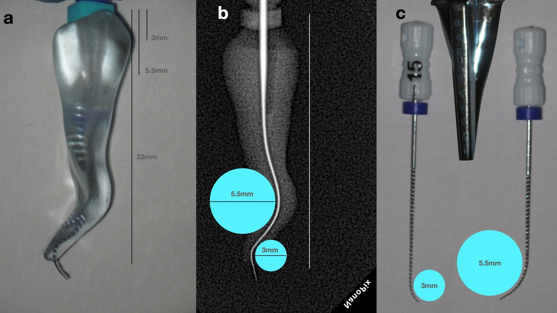 Contortion Tooth Management of Severe Curvatures and Complex Anatomy: A New Approach ...